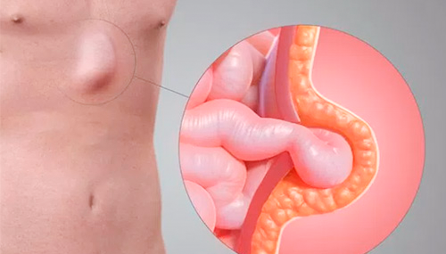 O que é hernia da parede abdominal